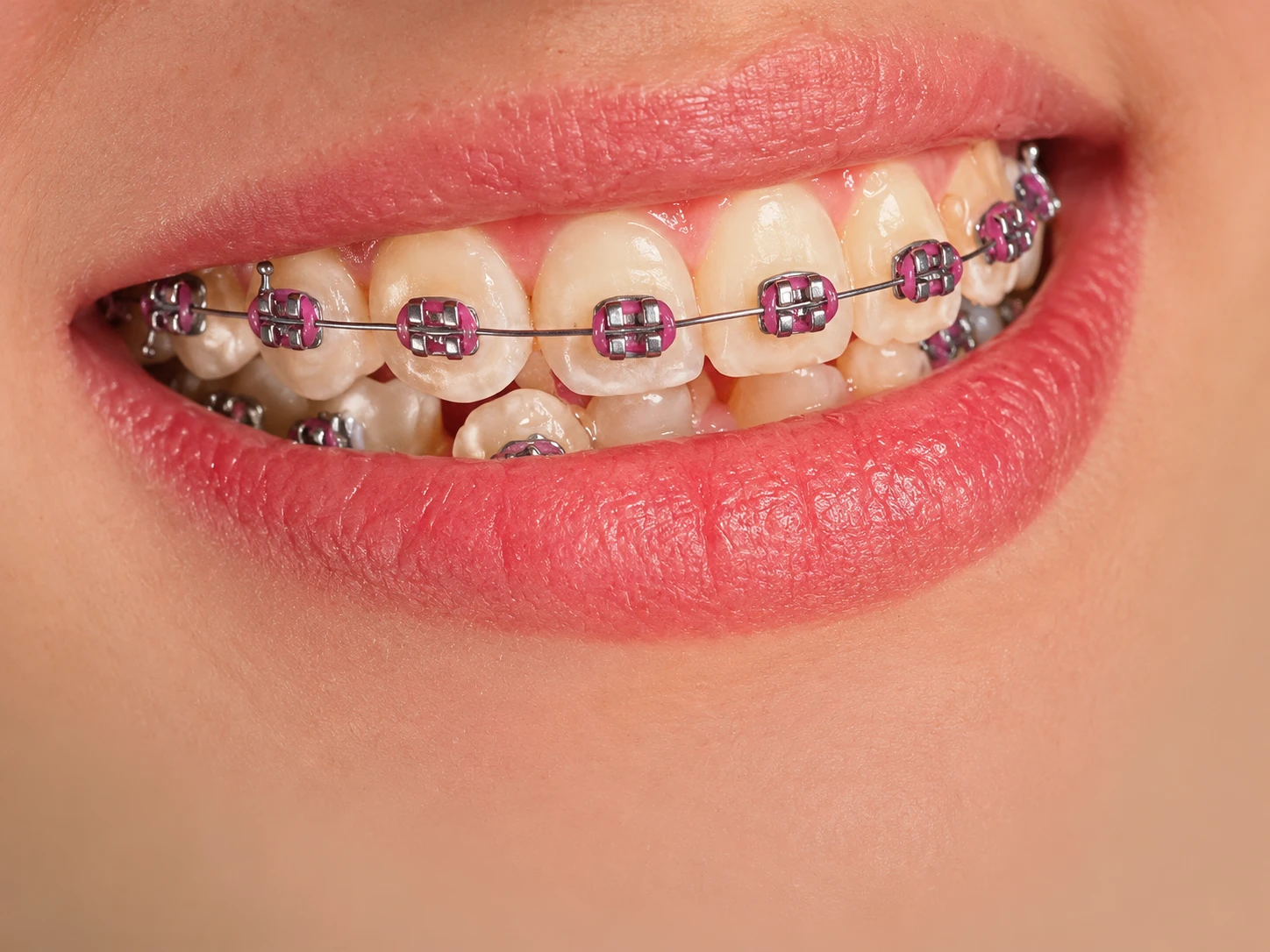 Sorriso com aparelho ortodôntico metálico e borrachinhas rosa